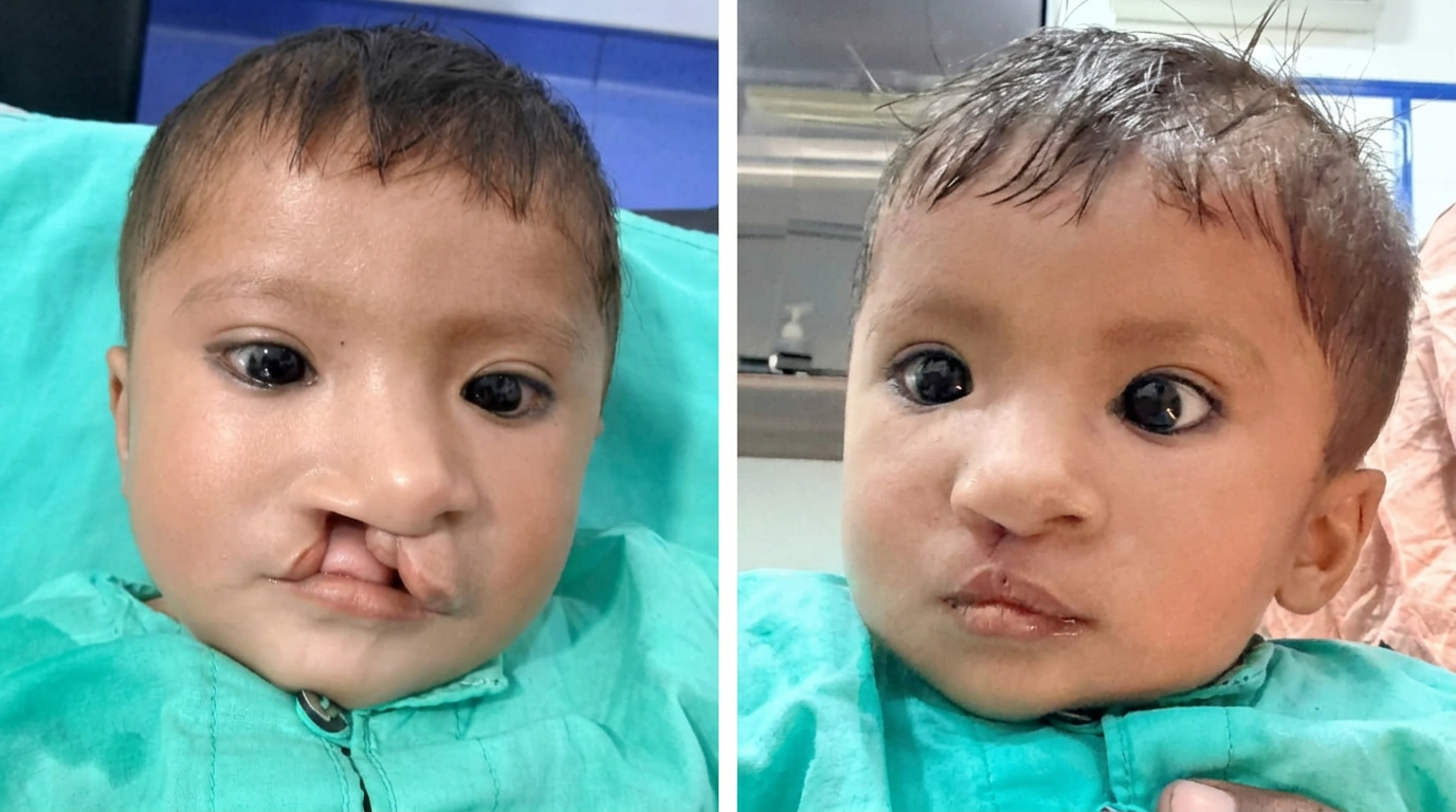 Cleft lip surgery before and after comparison
